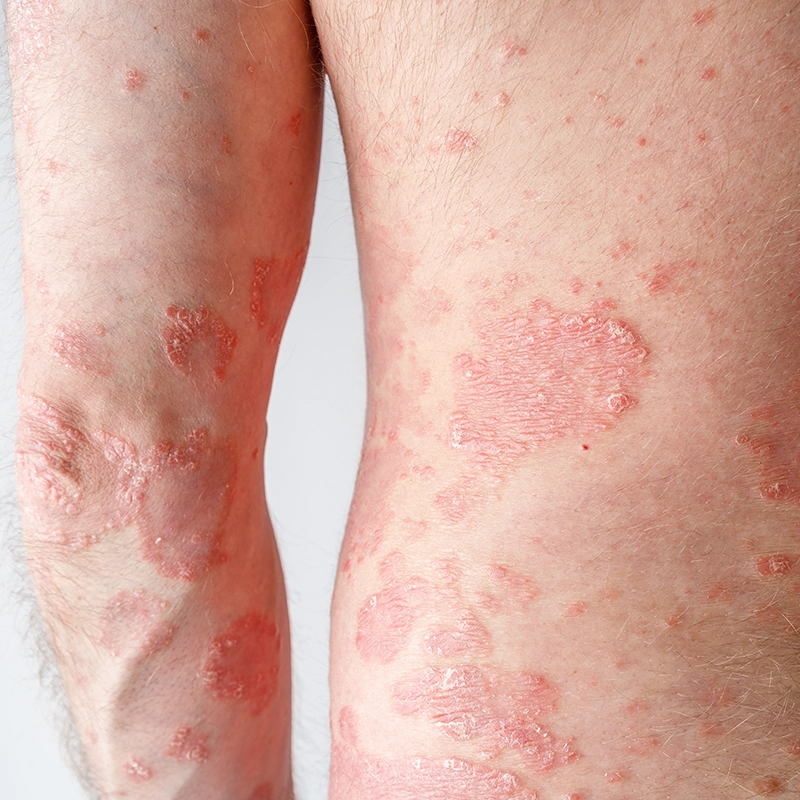 รักษาโรคสะเก็ดเงิน