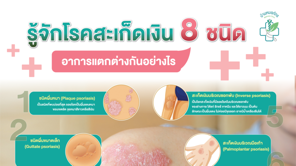 รู้จักโรคสะเก็ดเงิน 8 ชนิด