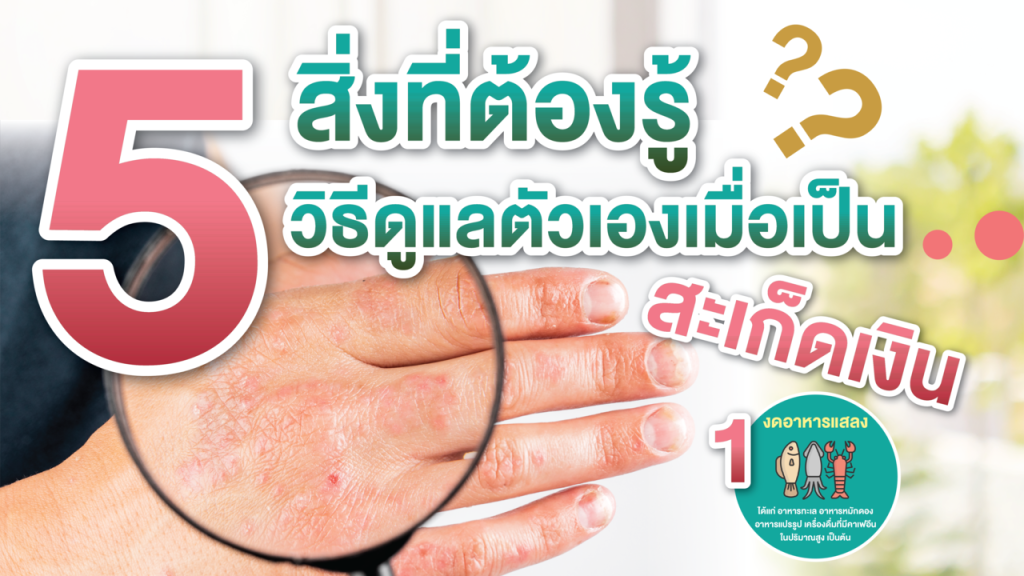 วิธีดูแลตัวเองเมื่อเป็นสะเก็ดเงิน