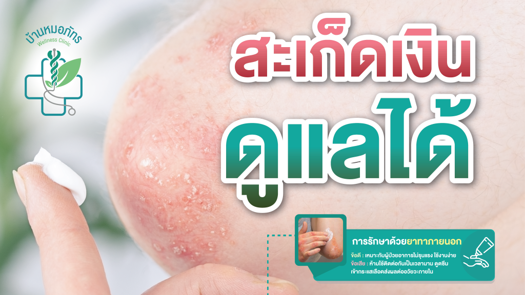 ดูแลรักษาสะเก็ดเงิน