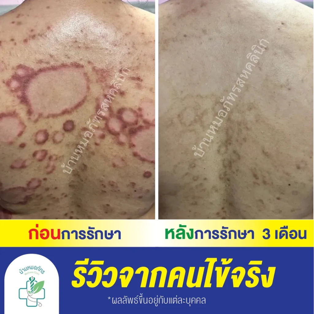 รักษาสะเก็ดเงินบ้านหมอภัทร