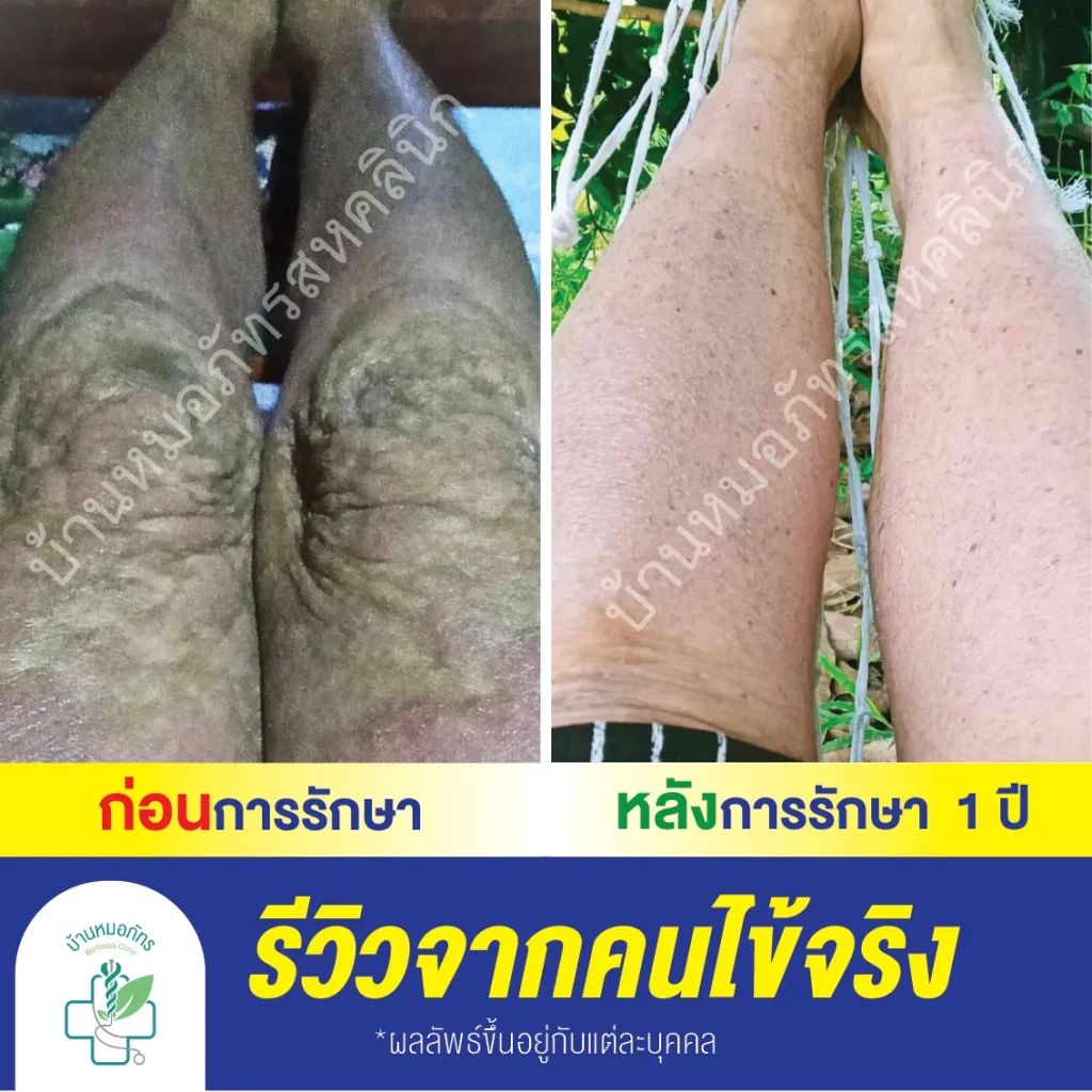 บ้านหมอภัทรรักษาสะเก็ดเงิน