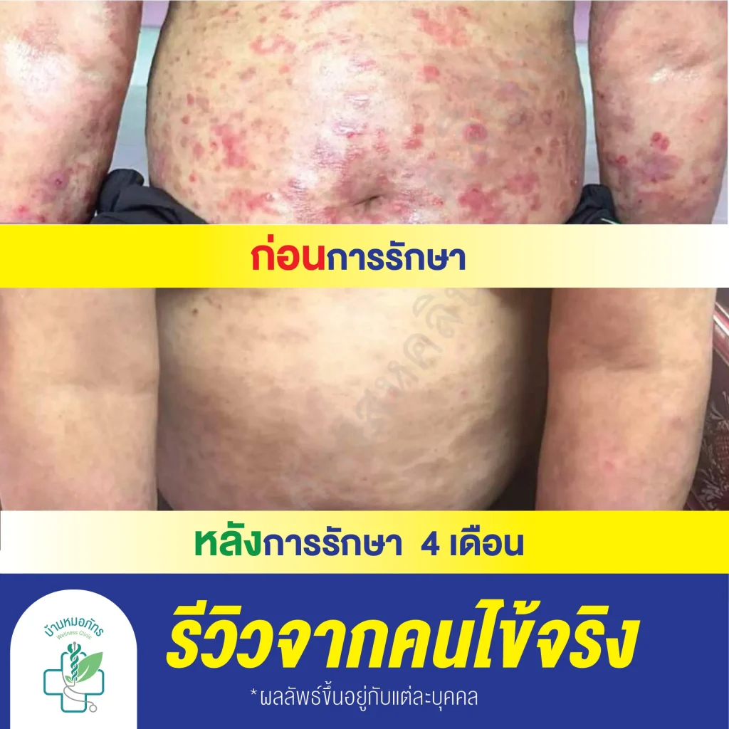 รีวิวรักษาสะเก็ดเงินบ้านหมอภัทร